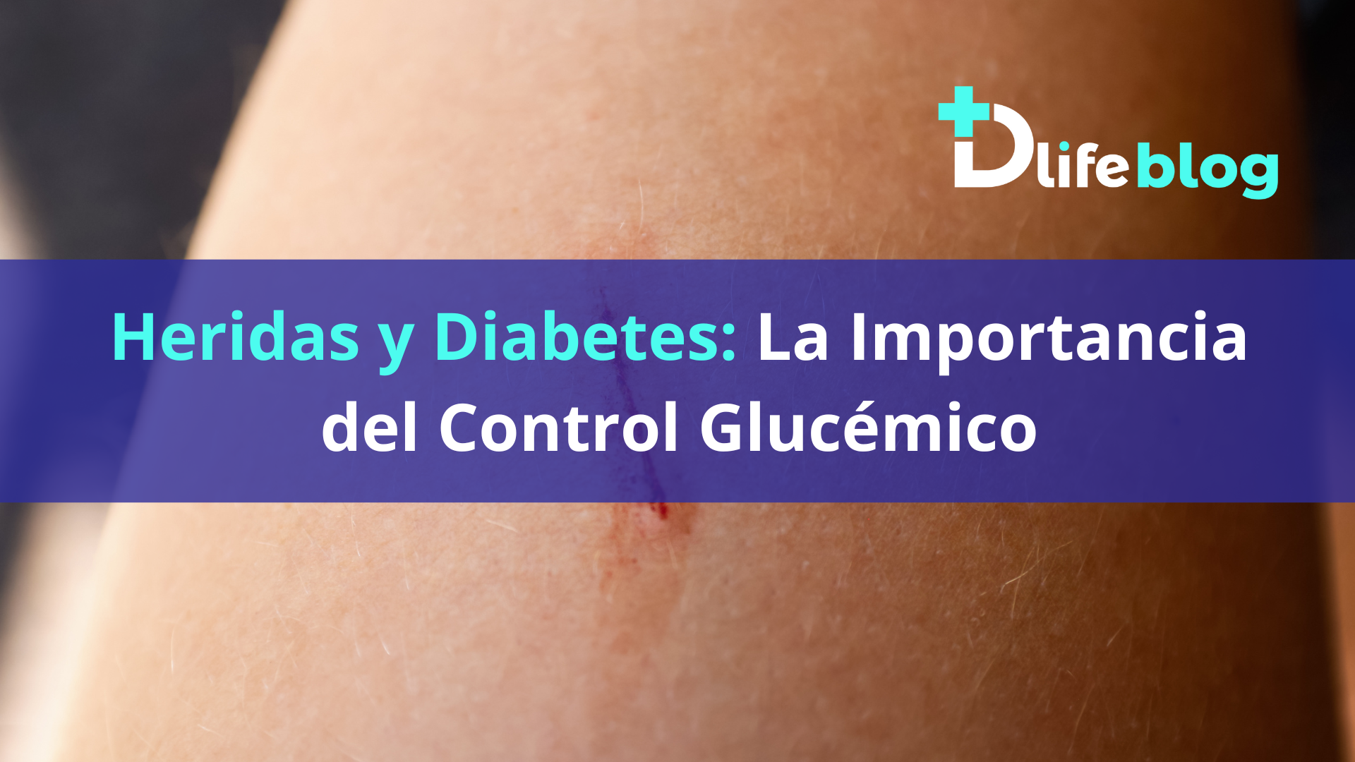 Heridas y Diabetes. Dlife Blog